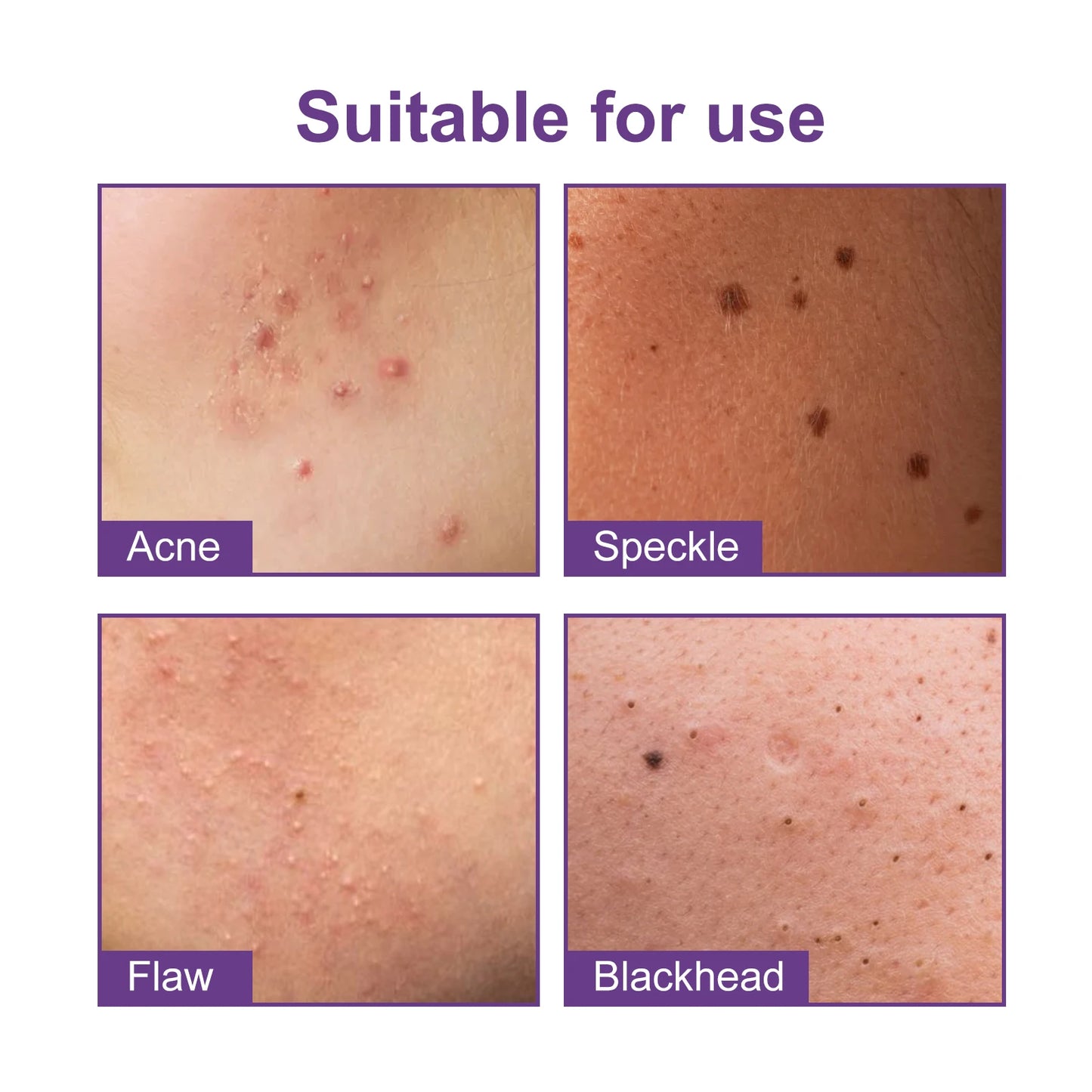 Facial Acne Patch Water Gel Acne Stickers Fade Acne suitable for Women