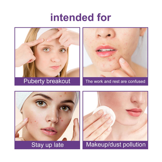 Facial Acne Patch Water Gel Acne Stickers Fade Acne suitable  for  Women